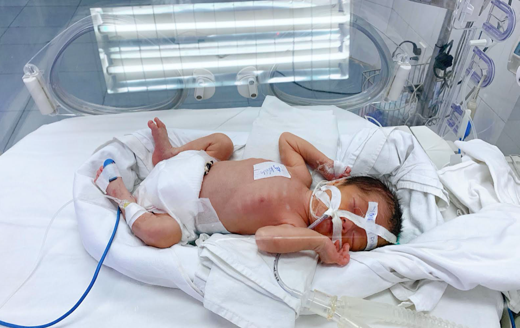 Con gái sản phụ Thanh Vân được nuôi dưỡng tại Khoa Sơ sinh - Bệnh viện Sản Nhi Bắc Giang. Ảnh: BVCC.