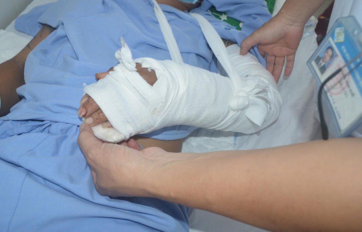 Bàn tay trái của bệnh nhân sau gần 4 ngày phẩu thuật đã cơ bản hồi phục. 