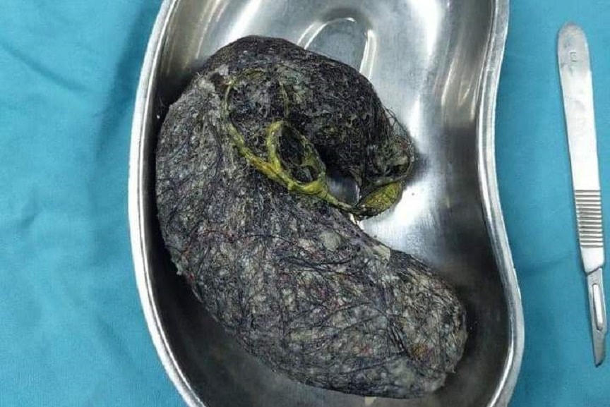 Túi tóc nặng 0,5 kg trong dạ dày bé gái được lấy ra ngoài.