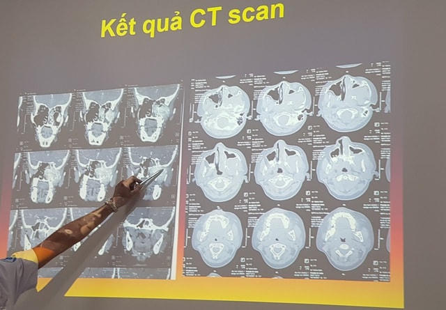 Kết quả CT-Scan cho thấy bệnh nhi bị khối u xơ rất lớn ở vùng vòm mũi họng bên trái.  