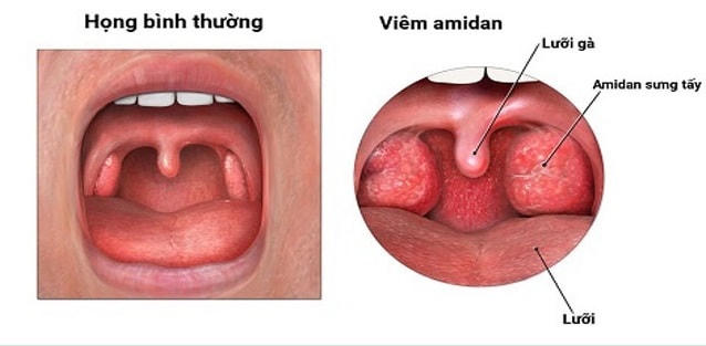 Viêm amidan có thể tự khỏi mà không cần điều trị.