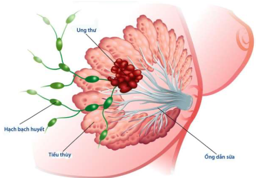Ung thư vú chia làm 05 giai đoạn. (Ảnh minh hoạ)
