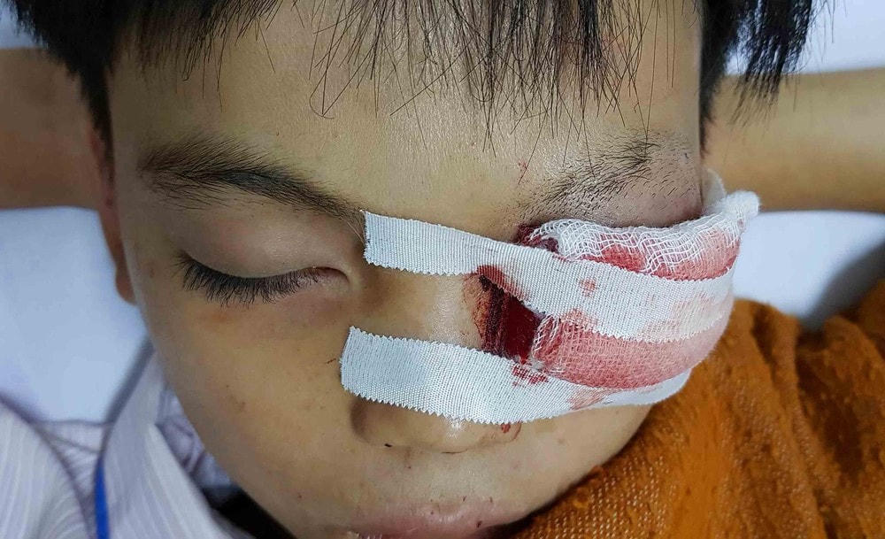 Một trường hợp chấn thương mắt do pháo.