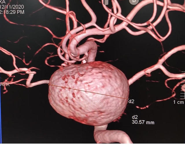 Ca bệnh bị phình mạch máu não khổng lồ được bác sĩ phát hiện.  