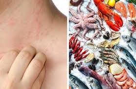 Các loại hải sản có vỏ như tôm, cua, nghêu, sò… dễ gây dị ứng.