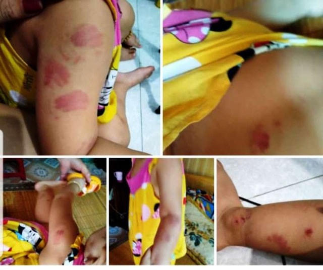 Hình ảnh những vết thương trên người cháu bé nghi do bị cắn.