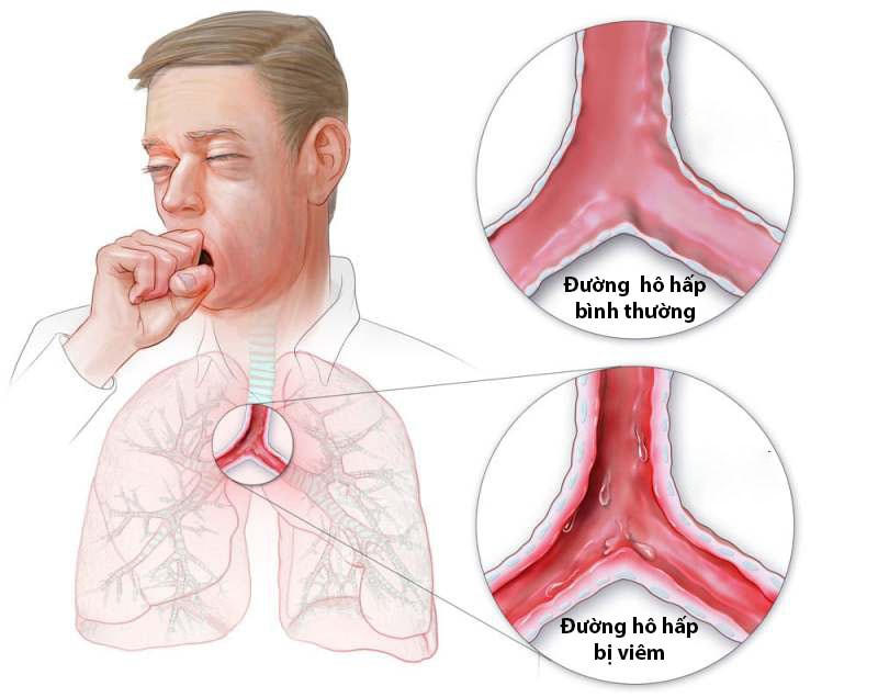 Viêm đường hô hấp là bệnh thường gặp khi trời lạnh. (Ảnh minh hoạ)