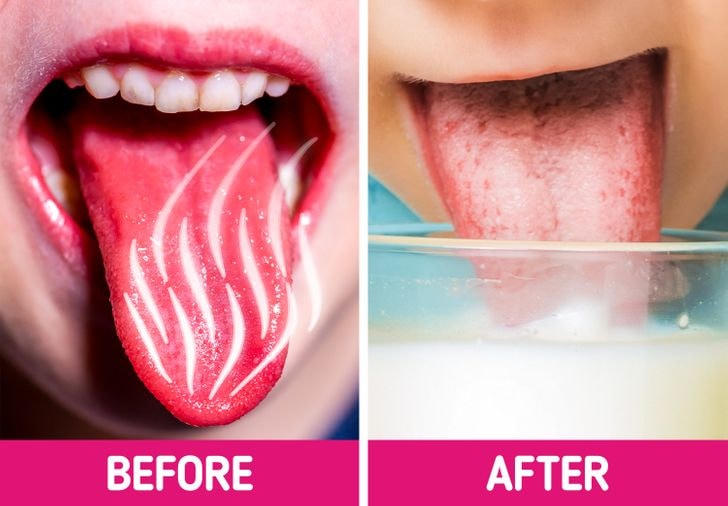 9 cách chữa lành vết bỏng lưỡi sau khi ăn đồ nóng