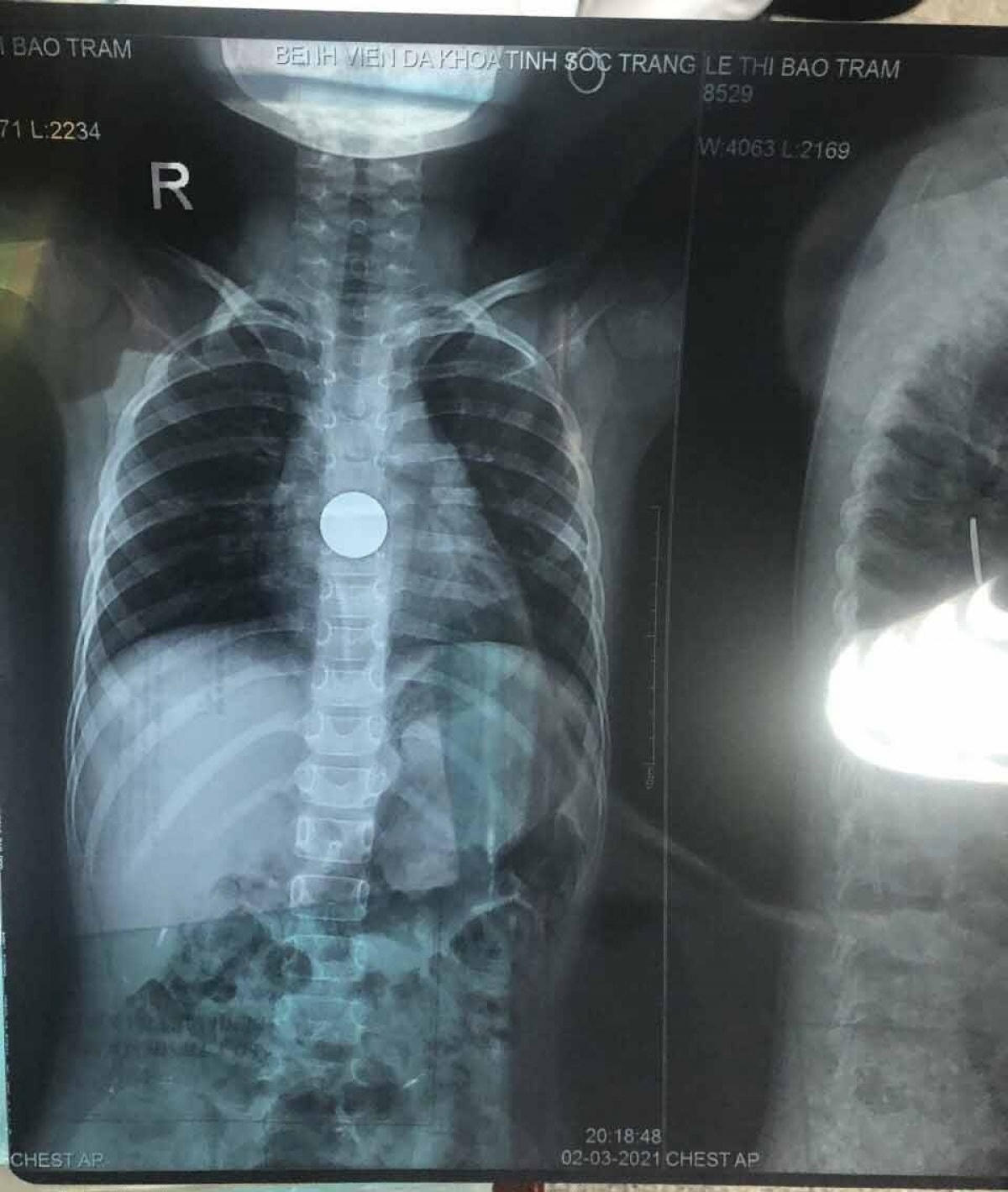 Dị vật được xác định là đồng xu trong cơ thể bé T qua hình ảnh chụp X-Quang.  