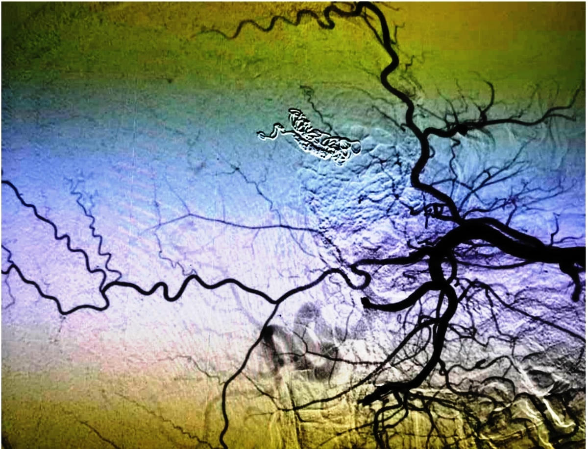 Vị trí dò đã được tắc hoàn toàn bằng coils sau khi can thiệp nội mạch.