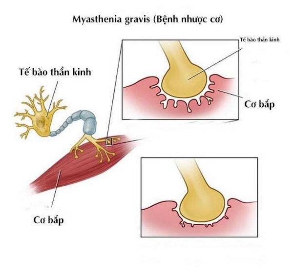 Nhược cơ là bệnh lý thần kinh cơ mạn tính.