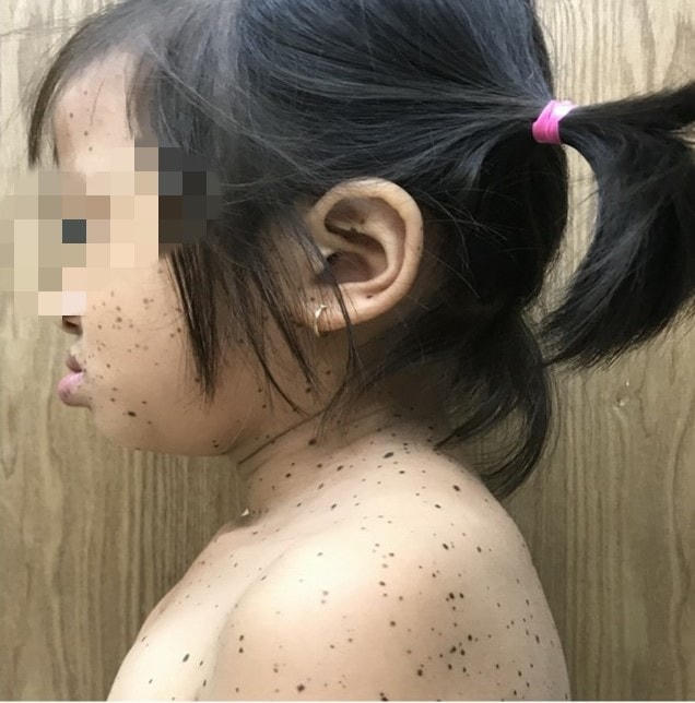 Bệnh nhân đầu tiên ở Việt Nam mắc hội chứng da báo