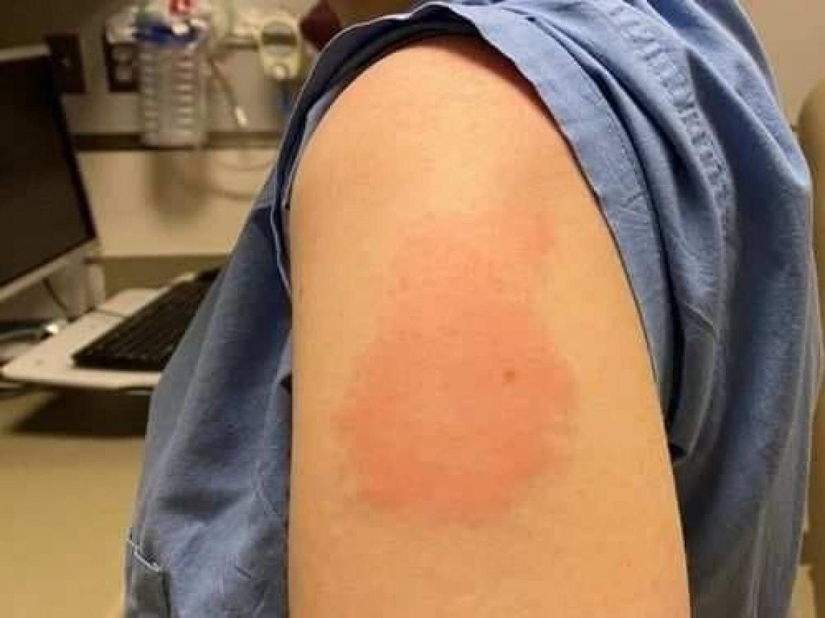 Những tác dụng phụ có thể xảy ra của vaccine Covid-19