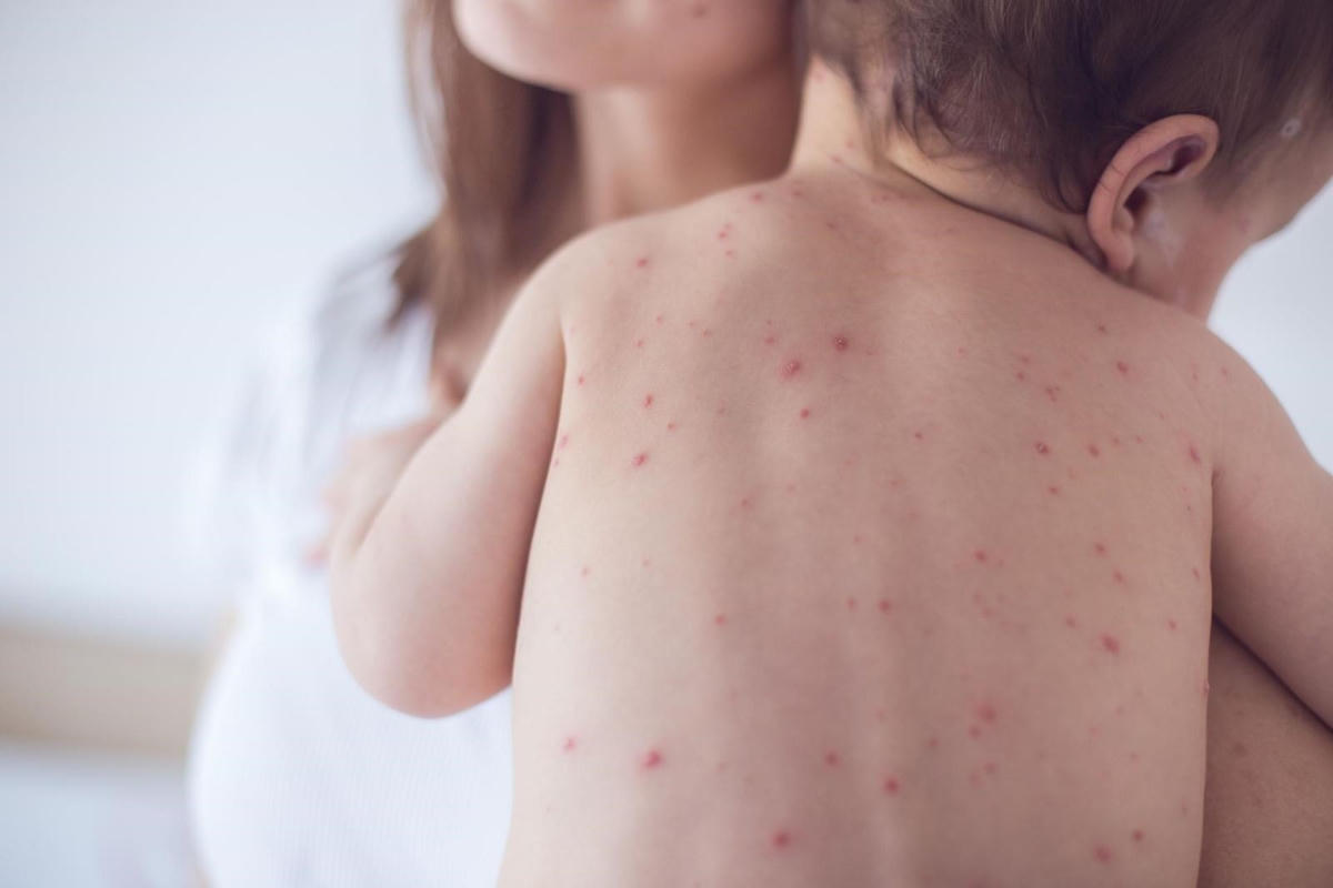 Cảnh giác bệnh thủy đậu