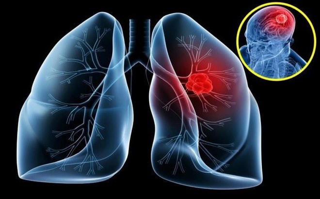 90% bệnh nhân ung thư phổi do hút thuốc lá.
