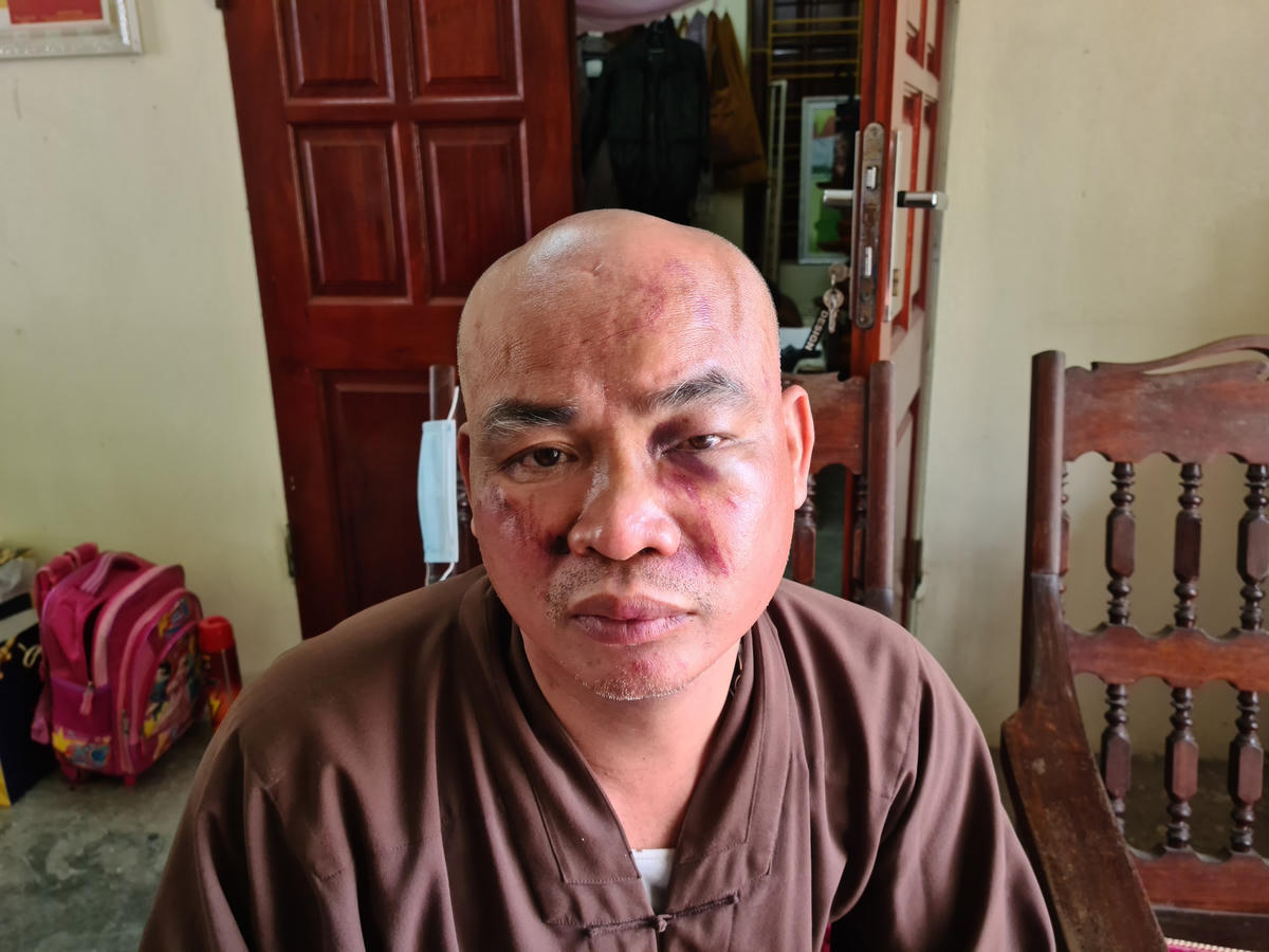 Đại đức Thích Nhẫn Kiên bị thương tích phần mặt. Ảnh: Nguyễn Đại