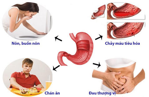 Dấu hiệu bệnh đau dạ dày (ảnh minh hoạ).