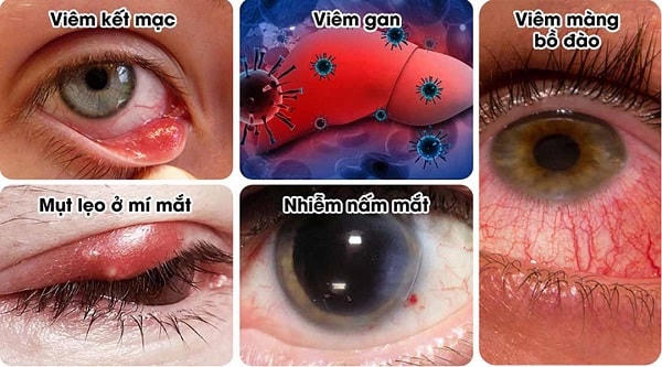 Các loại nhiễm trùng ở mắt là một trong những nguyên nhân gây co giật mí mắt. 
