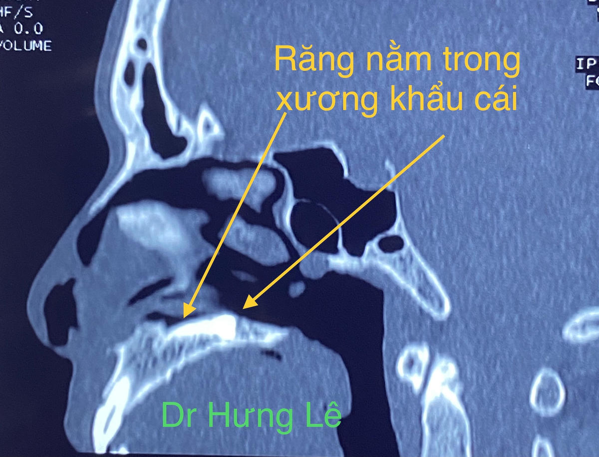 Clip dùng xẻng đào chiếc răng mọc lạc chỗ trong khoang mũi bệnh nhân