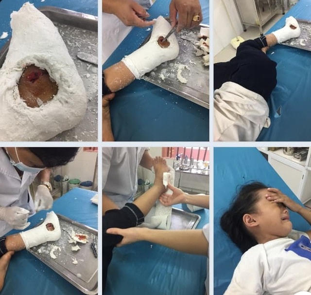 Cháu bị thương sau đó được đưa vào cơ sở y tế khám và băng bó. Bác sĩ cho biết, cháu Lê bị mẻ, rạn xương, một phần thanh sắt đâm vào chân làm lộ xương bên trong phải khâu nhiều mũi.