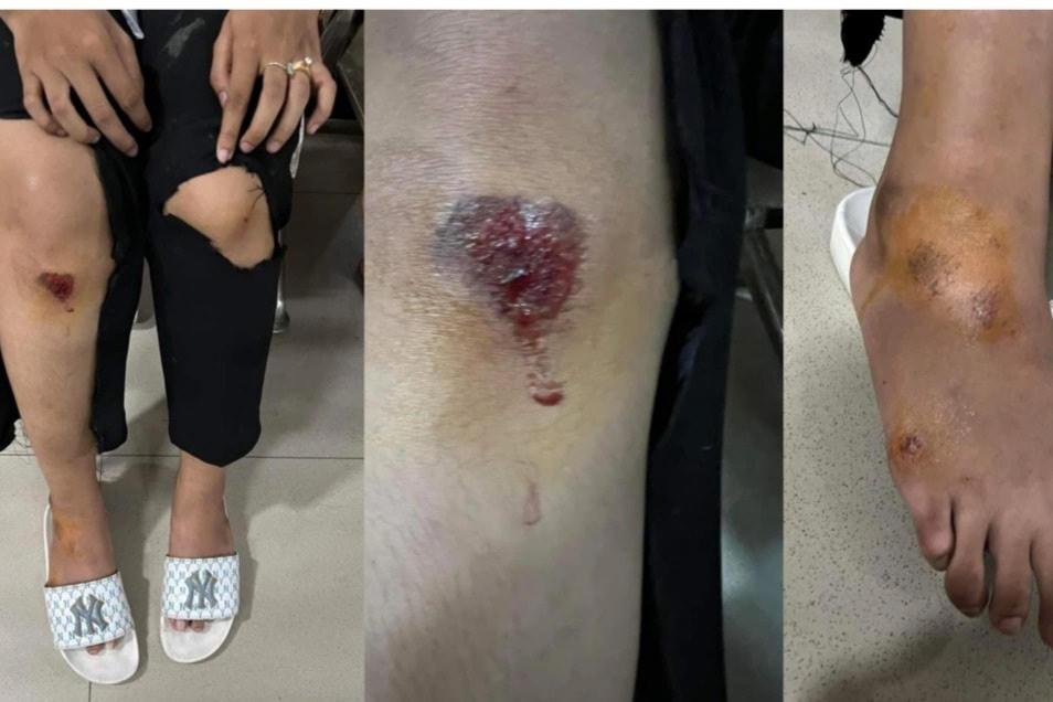 Hai nữ sinh bị nhiều vết thương ở tay, chân sau cú đạp ngã hai tên cướp.
