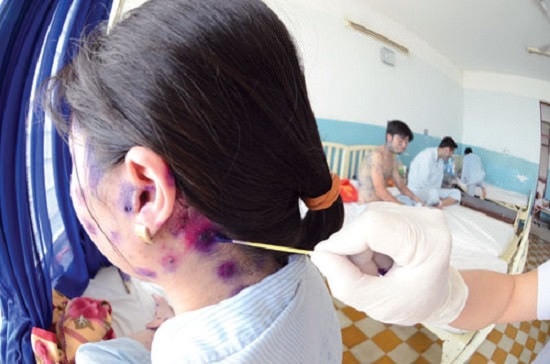 Mùa bệnh thủy đậu