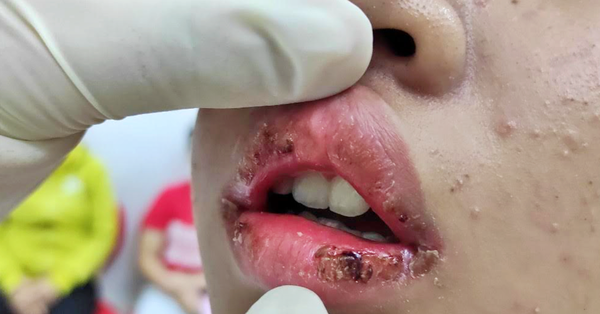 Môi bệnh nhân khô, sưng, ngứa, mưng mủ, rỉ máu khi vào BV cấp cứu.