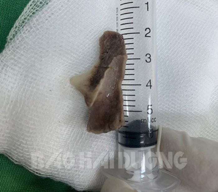 Dị vật nằm trong đường thở.