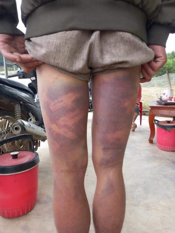 Những vết bầm trên 2 chân và vùng đùi của anh Bang.
