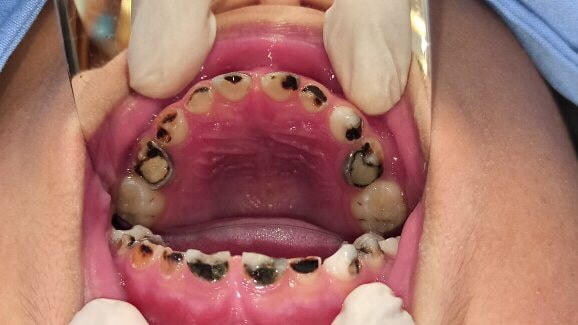 Sâu răng ẩn chứa nhiều nguy cơ về sức khỏe toàn thân, chi phí khắc phục lại vô cùng tốn kém. 