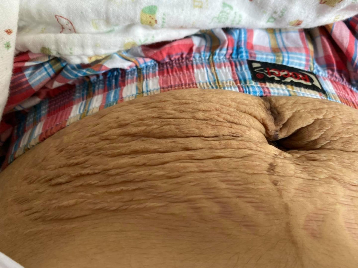 Vết rạn bụng sau sinh của Hoài Minzy.