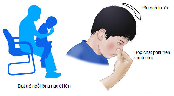 Khi trẻ bị chảy máu cam, hướng dẫn trẻ bóp chặt phía trên cánh mũi và giữ chặt trong khoảng 10 phút.
