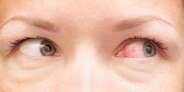 Đau mắt đỏ thường khởi phát đột ngột, lúc đầu ở một bên mắt.