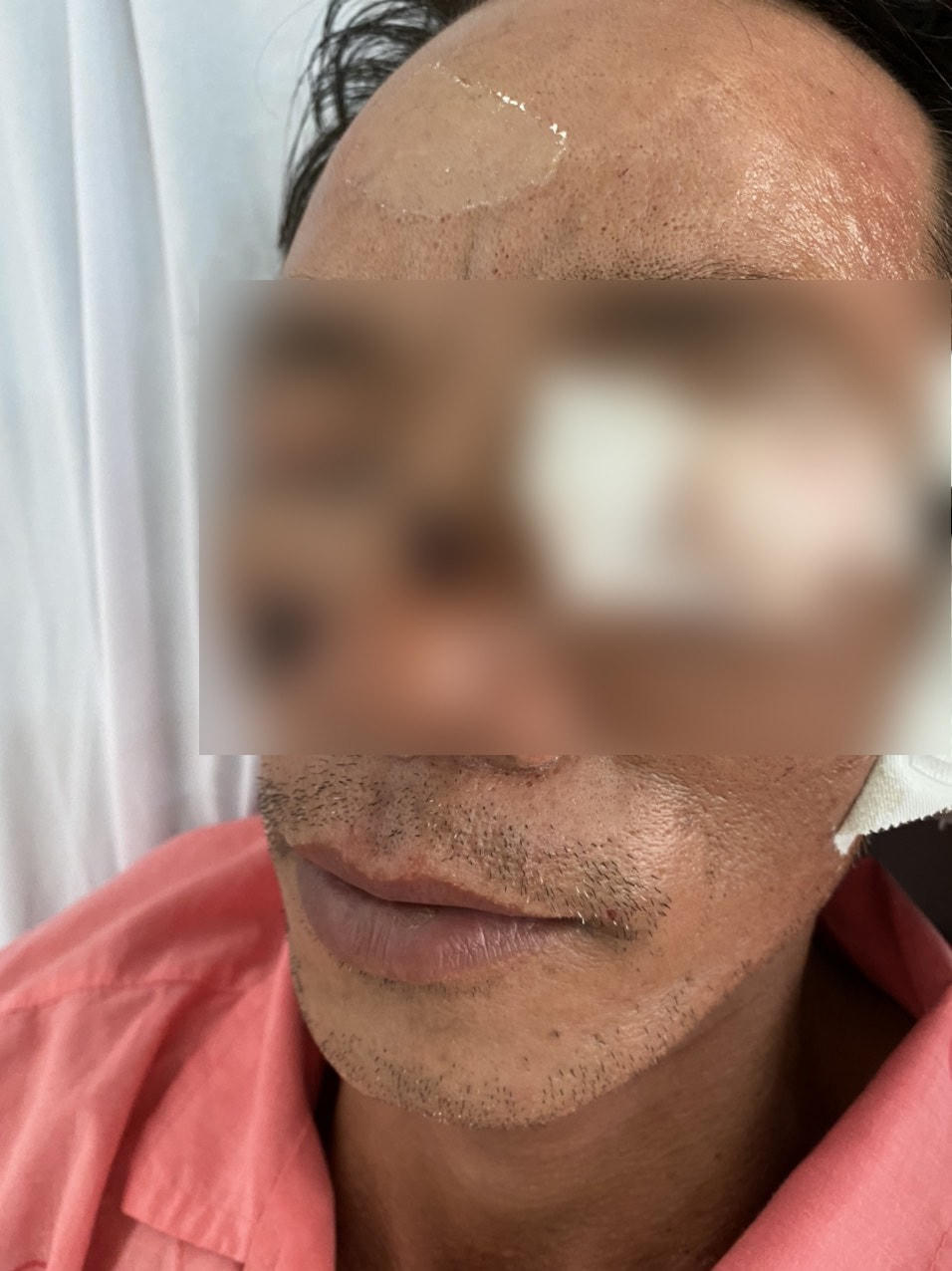 Một nam bệnh nhân bị tổn thương ở mắt do pháo nổ vừa được điều trị tại BV Chợ Rẫy. (Ảnh do BV cung cấp).