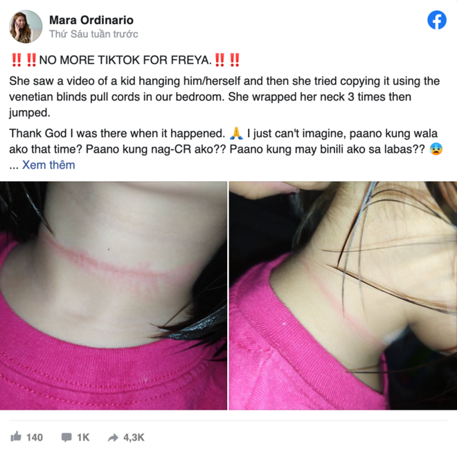 Cô bé 4 tuổi và vết hằn trên cổ.