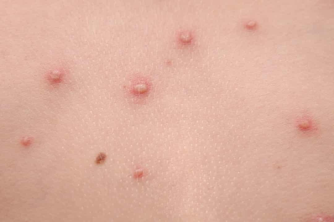 Nổi mụn nước đột ngột - Nếu trẻ bị nổi mụn nước đột ngột, hãy đưa trẻ đến bác sĩ ngay lập tức.