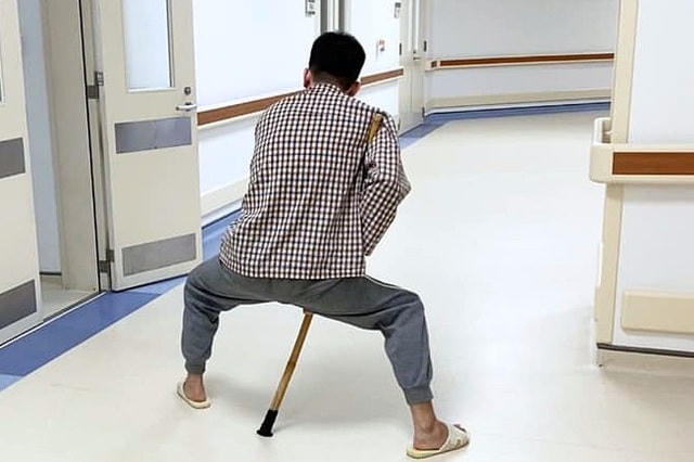 Bệnh nhân viêm cột sống dính khớp biến dạng nặng nề, 2 chân khuỳnh, xoay ra ngoài. Ảnh trước mổ.  