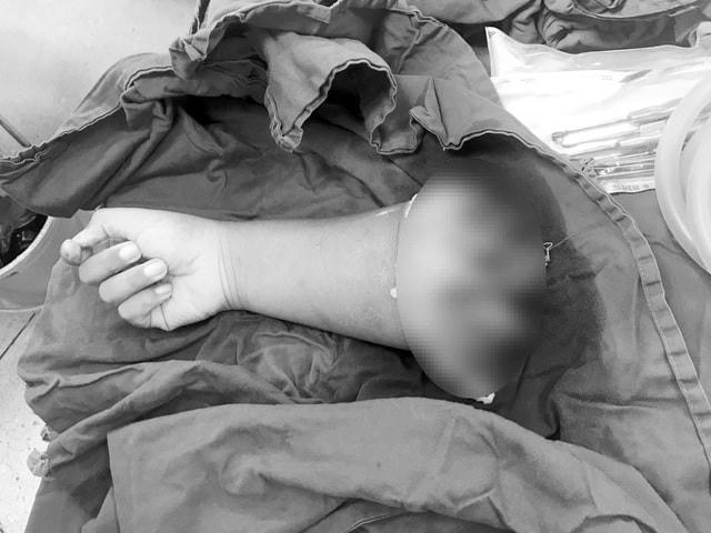 Cẳng tay bị đứt lìa của bệnh nhi được bảo quản lạnh thời điểm chuyển đến bệnh viện.