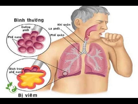 Người cao tuổi dễ nhiễm các bệnh hô hấp khi trời lạnh. (Ảnh minh hoạ)