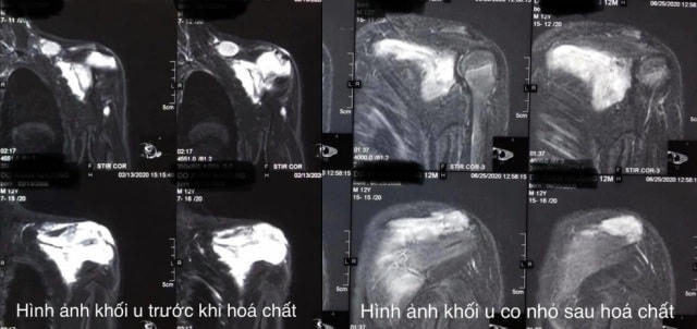 Hình ảnh khối u trước và sau khi được điều trị hóa chất.