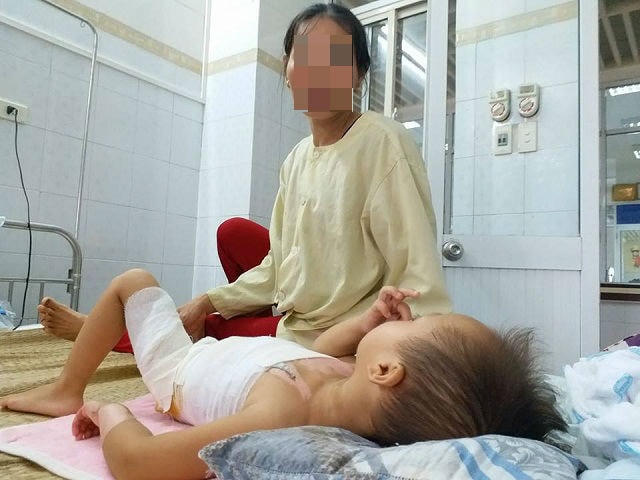 Một trường hợp trẻ bị bỏng.