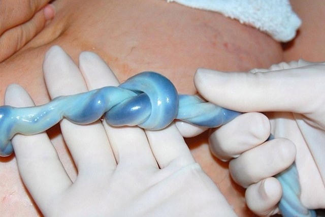 Dây rốn bị thắt nút, bé sơ sinh may mắn thoát chết trong gang tấc