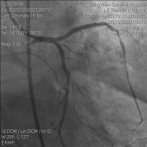Sau khi can thiệp chỗ tắc stent đã được tái thông