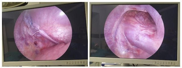 Hình ảnh lỗ thoát vị trước và sau phẫu thuật của bệnh nhi S.