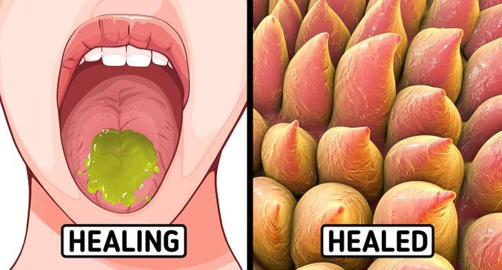 9 cách chữa lành vết bỏng lưỡi sau khi ăn đồ nóng