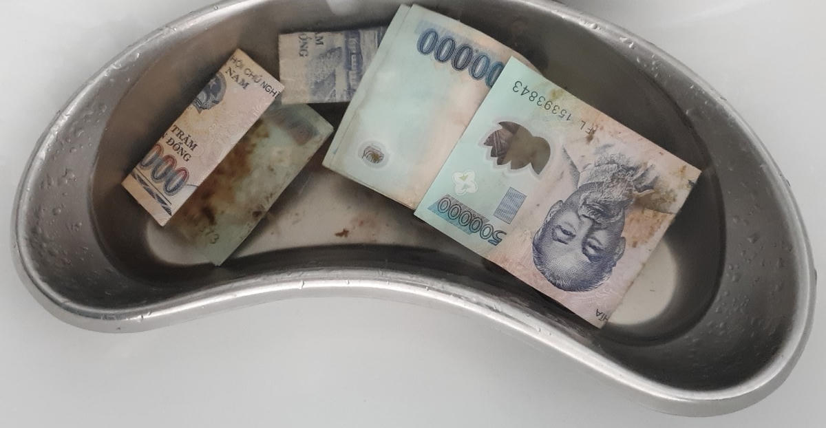 Số tiền lấy ra trong bụng bệnh nhân H.