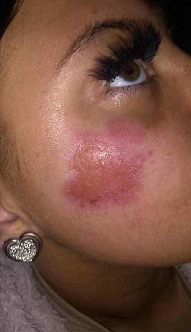 Vết bỏng trên mặt Amie Hall sau vụ nổ.