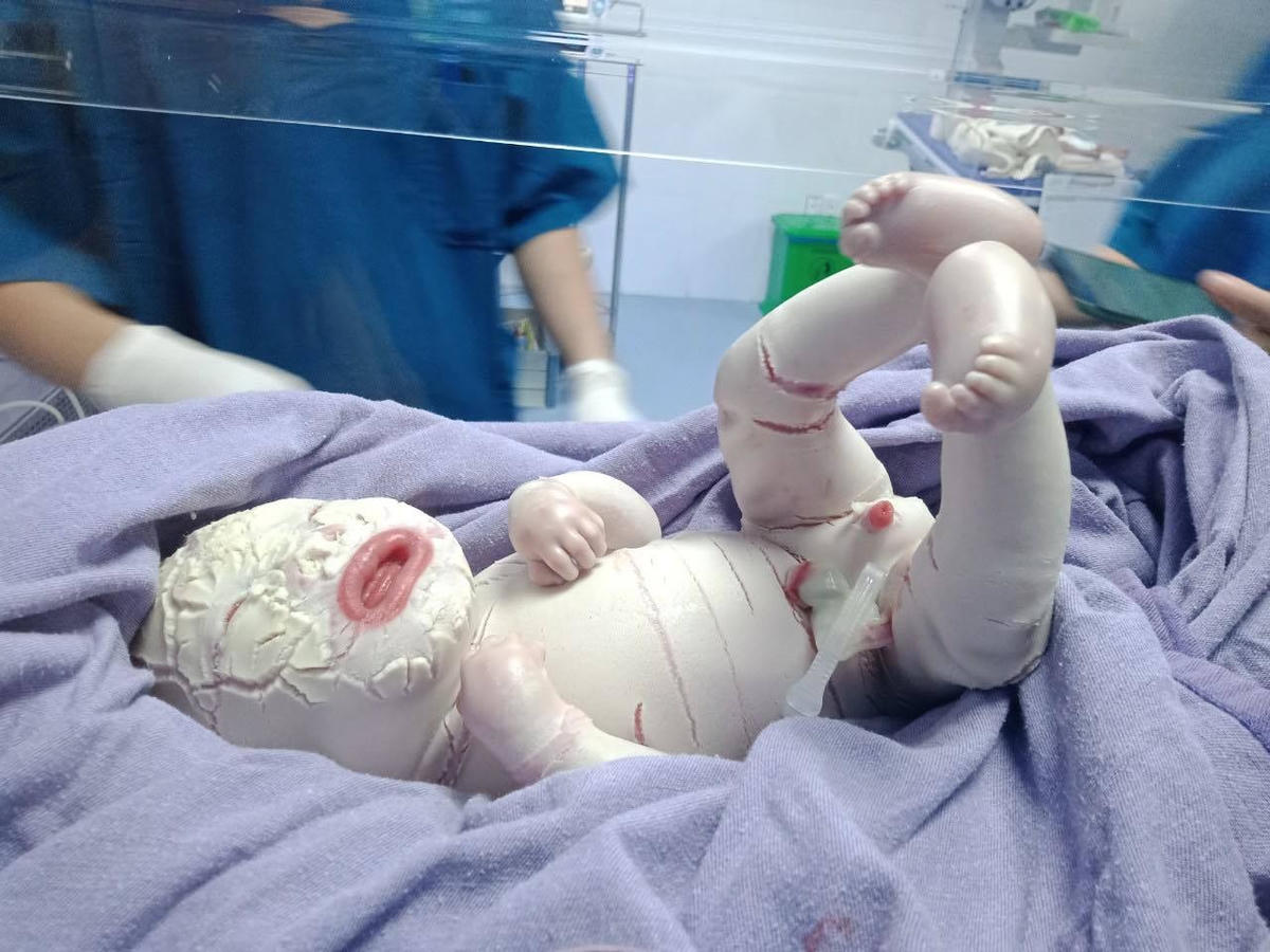 Trẻ sơ sinh ở Quảng Ninh mắc bệnh hiếm gặp, toàn thân bao phủ da dày bị rạn nứt thành từng mảng.