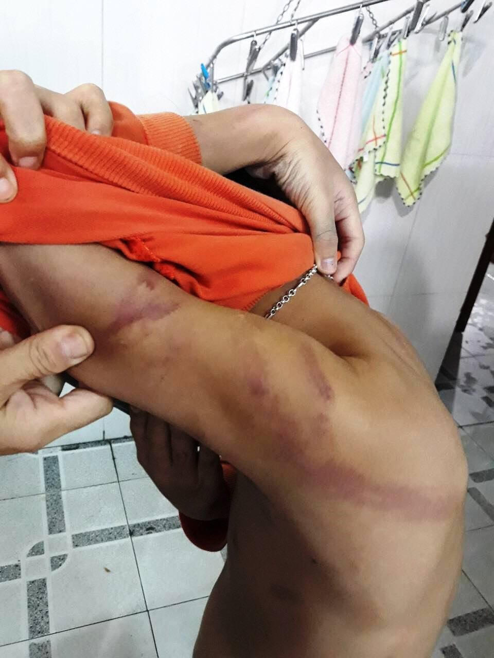 Vết thương bầm tím trên cơ thể cháu N.