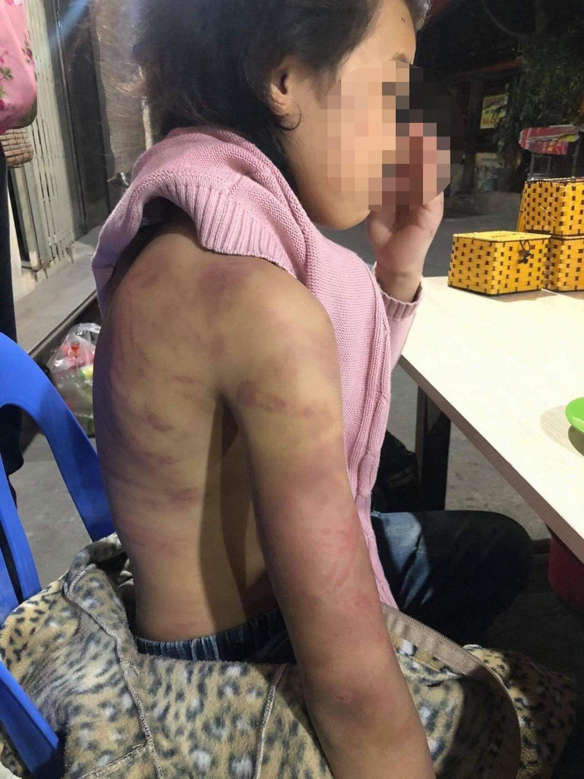   Toàn thân bé gái bị đánh đập tím tái. Ảnh người nhà cung cấp.